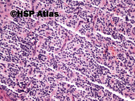 8. Rakowiak oskrzela (carcinoid tumor), 20x