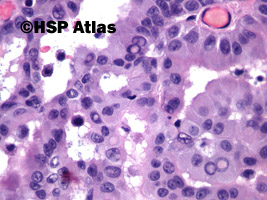 6. Międzybłoniak opłucnej (mesothelioma, epithelioid type), 40x