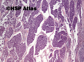 1. Rak drobnokomórkowy (small cell carcinoma), 4x