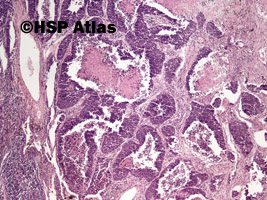 2. Rak drobnokomórkowy (small cell carcinoma), 4x