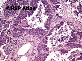 3. Rak drobnokomórkowy (small cell carcinoma), 10x