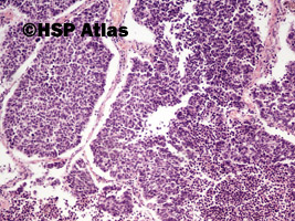 4. Small cell carcinoma, 10x