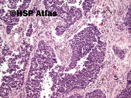 5. Rak drobnokomórkowy (small cell carcinoma), 10x