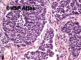 6. Rak drobnokomórkowy (small cell carcinoma), 20x