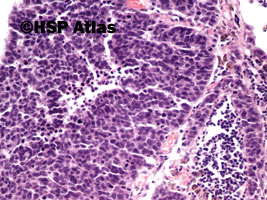 7. Small cell carcinoma, 20x