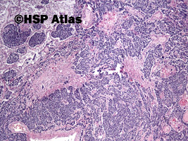 1. Złożony rak drobnokomórkowy (combined small cell carcinoma with neoplastic squamous components), 4x
