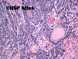3. Złożony rak drobnokomórkowy (combined small cell carcinoma with neoplastic squamous components), 10x