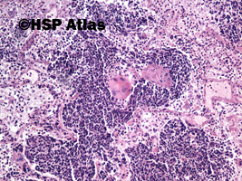 4. Combined small cell carcinoma with neoplastic squamous components, 10x