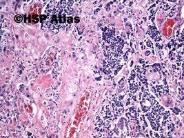 5. Combined small cell carcinoma with neoplastic squamous components, 10x