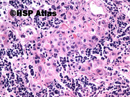 6. Combined small cell carcinoma with neoplastic squamous components, 20x