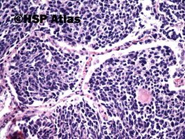 7. Combined small cell carcinoma with neoplastic squamous components, 20x