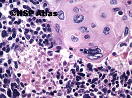 8. Złożony rak drobnokomórkowy (combined small cell carcinoma with neoplastic squamous components), 40x
