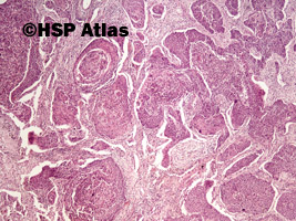 1. Rak płaskonabłonkowy (squamous cell carcinoma), 4x