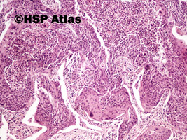 2. Rak płaskonabłonkowy (squamous cell carcinoma), 10x