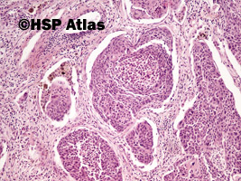3. Rak płaskonabłonkowy (squamous cell carcinoma), 10x