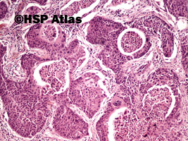 4. Rak płaskonabłonkowy (squamous cell carcinoma), 10x
