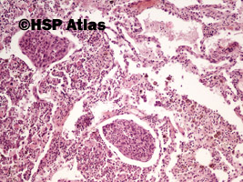 5. Squamous cell carcinoma, 10x