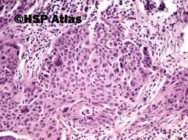 6. Rak płaskonabłonkowy (squamous cell carcinoma), 20x