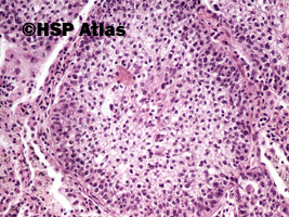 7. Rak płaskonabłonkowy (squamous cell carcinoma), 20x