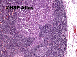1. Przerzut raka gruczołowego do węzła chłonnego (adenocarcinoma metastasis to lymph node), 4x