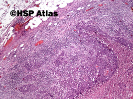 2. Przerzut raka gruczołowego do węzła chłonnego (adenocarcinoma metastasis to lymph node), 4x