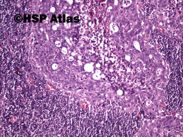 4. Przerzut raka gruczołowego do węzła chłonnego (adenocarcinoma metastasis to lymph node), 10x