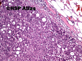 5. Przerzut raka gruczołowego do węzła chłonnego (adenocarcinoma metastasis to lymph node), 10x