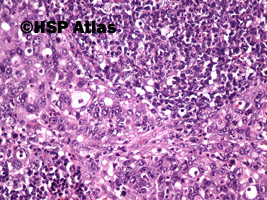 6. Przerzut raka gruczołowego do węzła chłonnego (adenocarcinoma metastasis to lymph node), 20x