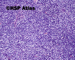 3. Chronic lymphocytic leukemia (CLL) - prolymphocytes, paraimmunoblasts, 10x