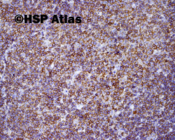 4. Przewlekła białaczka limfocytowa (Chronic lymphocytic leukemia - CLL), CD5