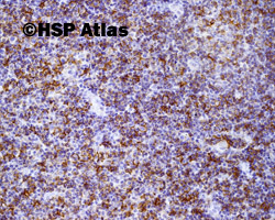 5. Przewlekła białaczka limfocytowa (Chronic lymphocytic leukemia - CLL), CD23