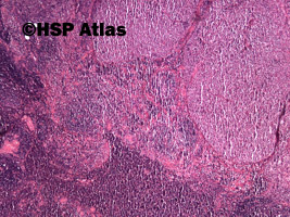 1. Pierwotny chłoniak śródpiersia (grasicy) z dużych komórek B (Primary
mediastinal [thymic]) large B-cell lymphoma, PMBL), 4x