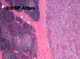 2. Pierwotny chłoniak śródpiersia (grasicy) z dużych komórek B (Primary
mediastinal [thymic]) large B-cell lymphoma, PMBL), 4x