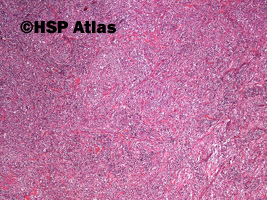 3. Pierwotny chłoniak śródpiersia (grasicy) z dużych komórek B (Primary
mediastinal [thymic]) large B-cell lymphoma, PMBL), 4x