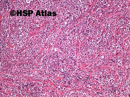 4. Pierwotny chłoniak śródpiersia (grasicy) z dużych komórek B (Primary
mediastinal [thymic]) large B-cell lymphoma, PMBL), 10x