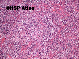 5. Pierwotny chłoniak śródpiersia (grasicy) z dużych komórek B (Primary
mediastinal [thymic]) large B-cell lymphoma, PMBL), 10x