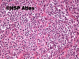 6. Primary mediastinal (thymic) large B-cell lymphoma (PMBL), 20x