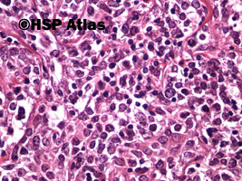 7. Pierwotny chłoniak śródpiersia (grasicy) z dużych komórek B (Primary
mediastinal [thymic]) large B-cell lymphoma, PMBL), 40x