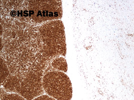 9. CD3, thymus (left) and lymphoma (right), 10x