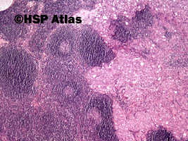 1. Przerzut raka wątrobowokomórkowego do węzła chłonnego (hepatocellular carcinoma metastasis to lymph node), 4x