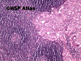 2. Przerzut raka wątrobowokomórkowego do węzła chłonnego (hepatocellular carcinoma metastasis to lymph node), 10x