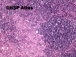 3. Przerzut raka wątrobowokomórkowego do węzła chłonnego (hepatocellular carcinoma metastasis to lymph node), 10x
