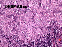4. Przerzut raka wątrobowokomórkowego do węzła chłonnego (hepatocellular carcinoma metastasis to lymph node), 20x