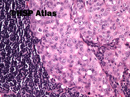 5. Przerzut raka wątrobowokomórkowego do węzła chłonnego (hepatocellular carcinoma metastasis to lymph node), 20x
