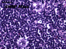 1. Komórki L&H (Popcorn cells) - wariant komórek Reed - Sternberga, 40x