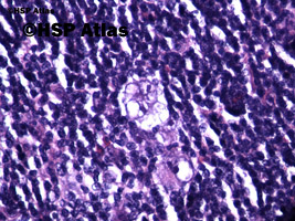 2. Komórka L&H (Popcorn cell) - wariant komórek Reed - Sternberga, 40x