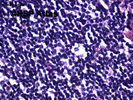 5. Komórka lakunarna (Lacunar cell) - wariant komórek Reed - Sternberga, 40x