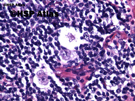 6. Komórka lakunarna (Lacunar cell) - wariant komórek Reed - Sternberga, 40x
