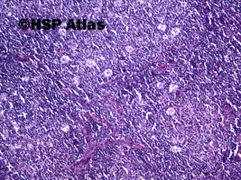 3. Klasyczny Chłoniak Hodgkina - bogaty w limfocyty (lymphocyte-rich, LR), 10x