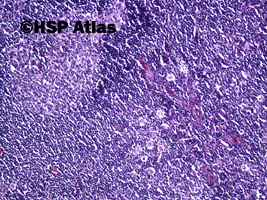 4. Klasyczny Chłoniak Hodgkina - bogaty w limfocyty (lymphocyte-rich, LR), 10x